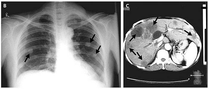 Plain radiography of the chest showed multiple nodular opacities in both lungs. Computed tomography of the abdomen revealed multiple lesions in the liver.