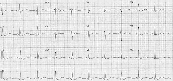 Read more about the article ECG Case 222