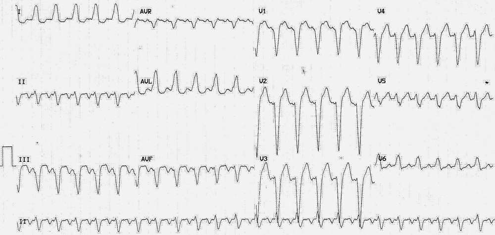 Read more about the article ECG Case 224