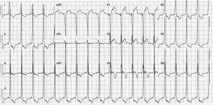 Read more about the article ECG Case 227