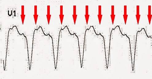 Lead V1 with atrial activity marked (red arrows)