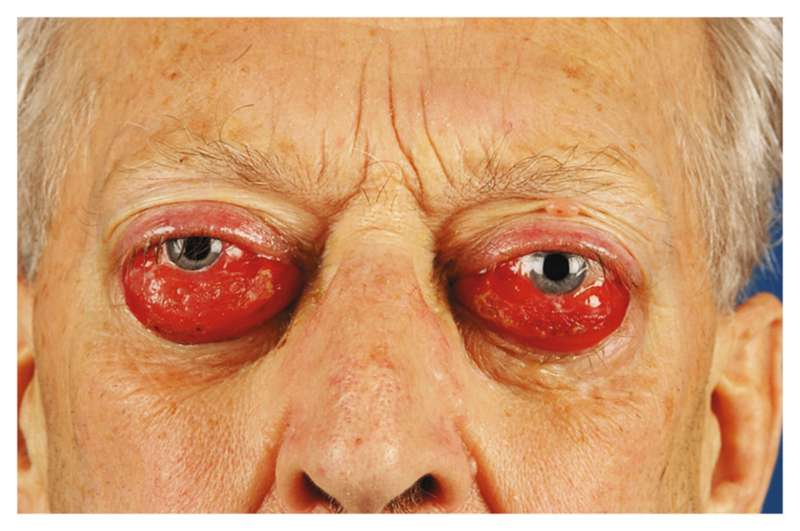 Read more about the article Painless Swelling and Redness of Both Eyes