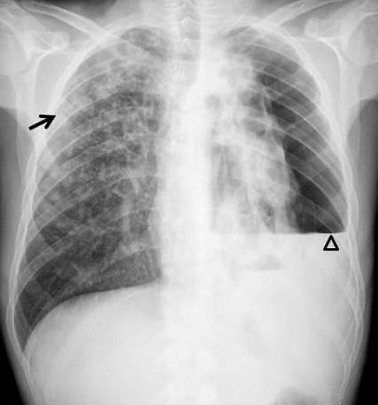 Chest radiograph reveals left-sided air-fluid level (arrowhead) with pneumothorax and consolidations in the right upper lobe and upper segment of the right lower lobe (arrow).