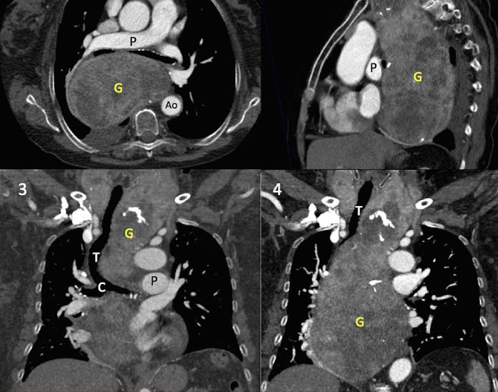 Contrast-enhanced CT showing a large heterogeneously enhancing soft tissue mass occupies the posterior right mediastinum. It displaces and compresses multiple structures