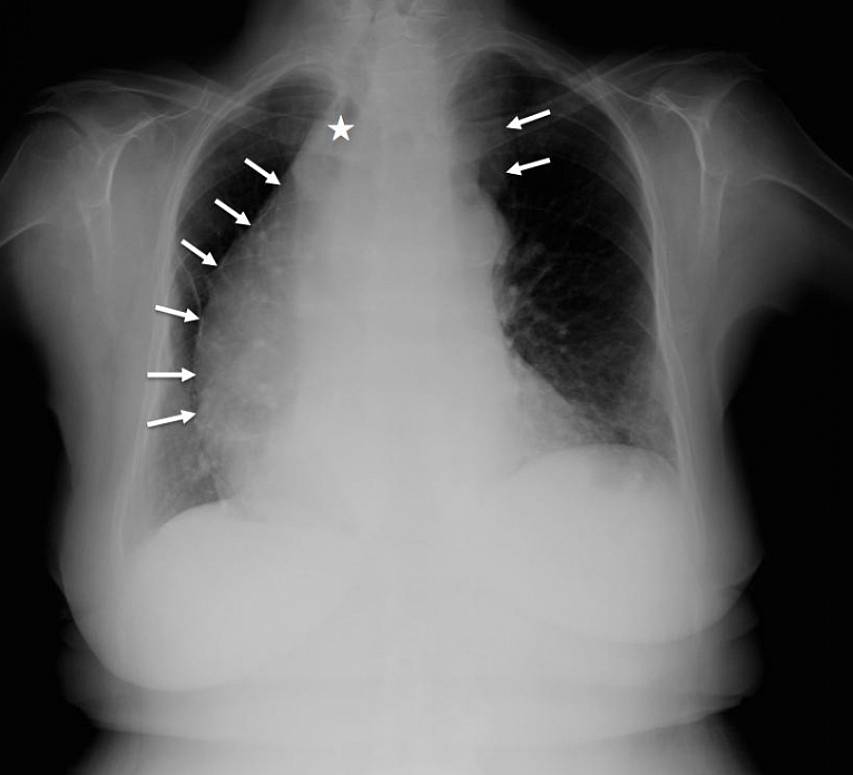 Posterior-anterior chest radiograph showing enlarged mediastinum secondary to a huge mass (arrows). It significantly occupies the right hemithorax and causes deviation of the trachea (star)