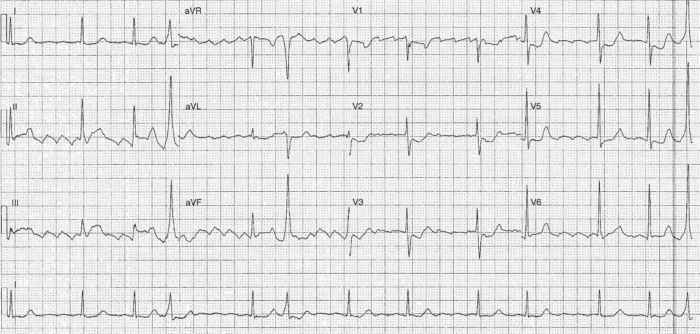 Read more about the article ECG Case 228