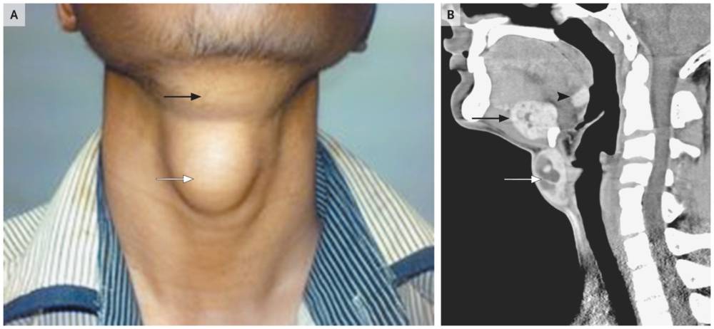 Ectopic Thyroid Tissue