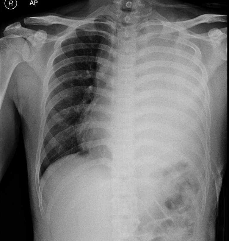 Chest X-ray of a patient with shortness of breath, decreased appetite, fatigue and fever