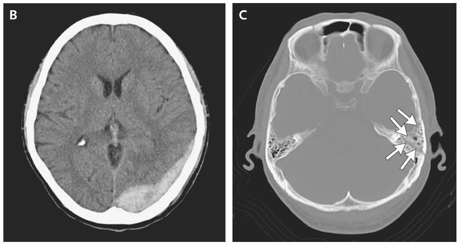 Computed tomography revealed an acute epidural hematoma (Panel B), accompanied by a left temporal bone fracture (Panel C, arrows)