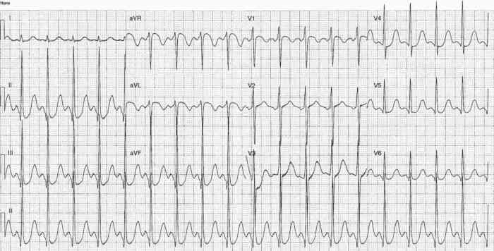 Read more about the article ECG Case 233