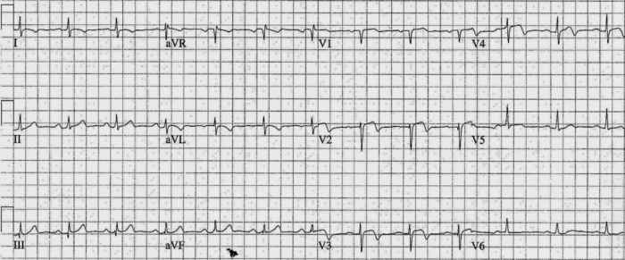 Read more about the article ECG Case 234