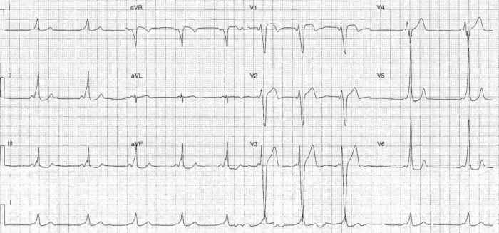 Read more about the article ECG Case 236