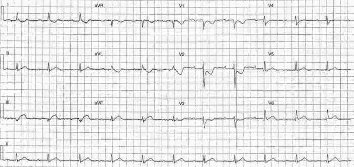 Read more about the article ECG Case 237