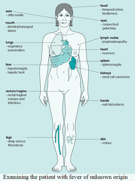 Examining the patient with fever of unknown origin (FUO)