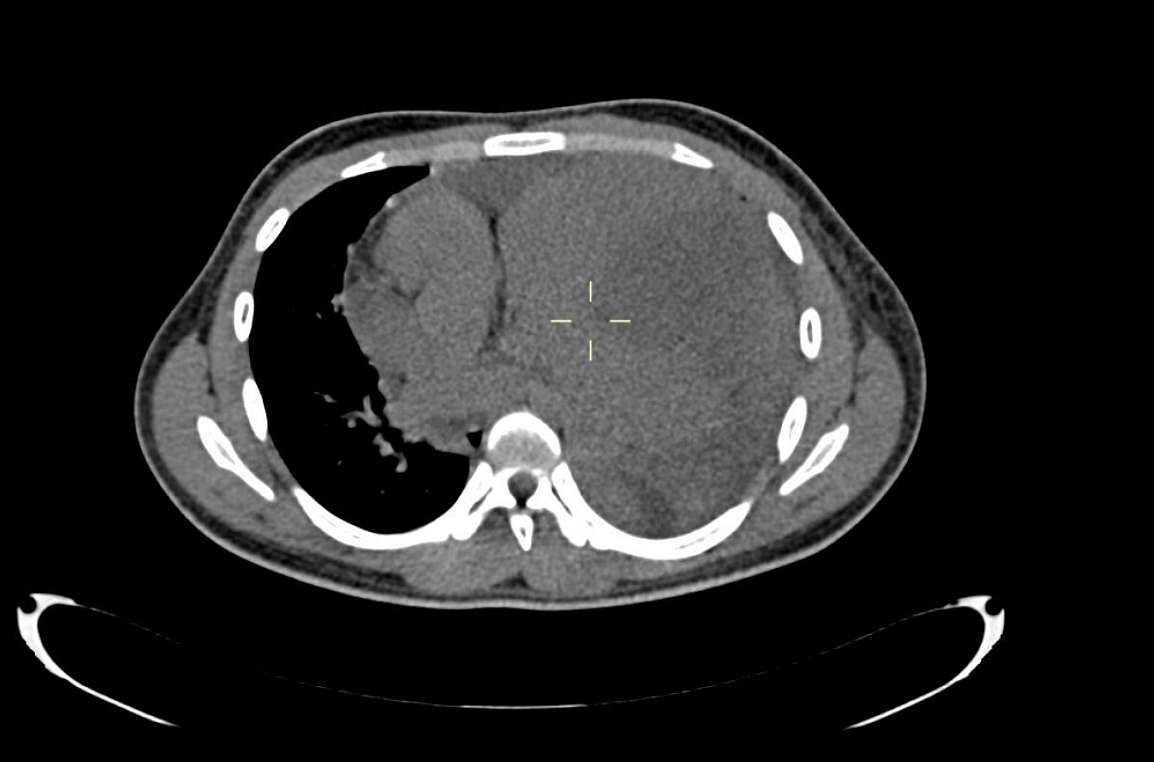 Plain chest axial CT shows a large left anterior mediastinal mass lesion without fat, without calcification, displacing the heart towards the right.