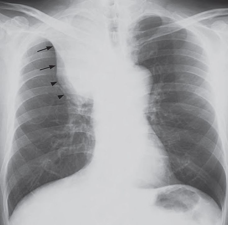 The ‘Golden S sign’ – collapse of the right upper lobe with a well demarcated lateral border formed by the elevated horizontal fissure (arrows), and a focal convex bulge at the apex due to the centrally located bronchogenic carcinoma (arrowheads).