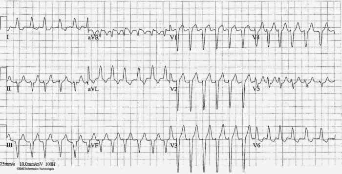 Read more about the article ECG Case 238