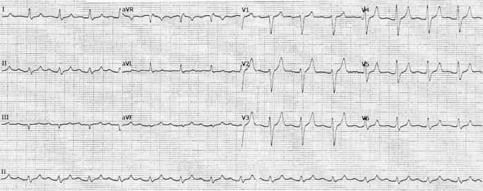 Read more about the article ECG Case 239