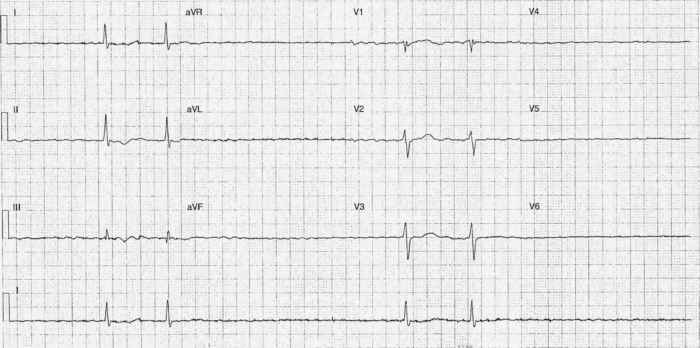 Read more about the article ECG Case 241