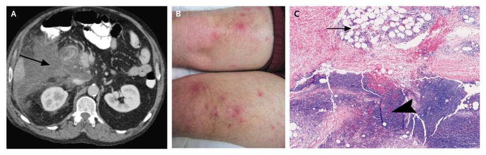 Lobular Pancreatic Panniculitis