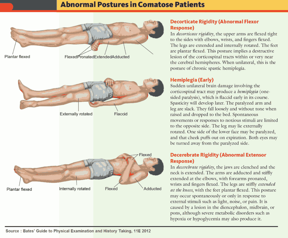 Abnormal Postures in Coma and Comatose Patients