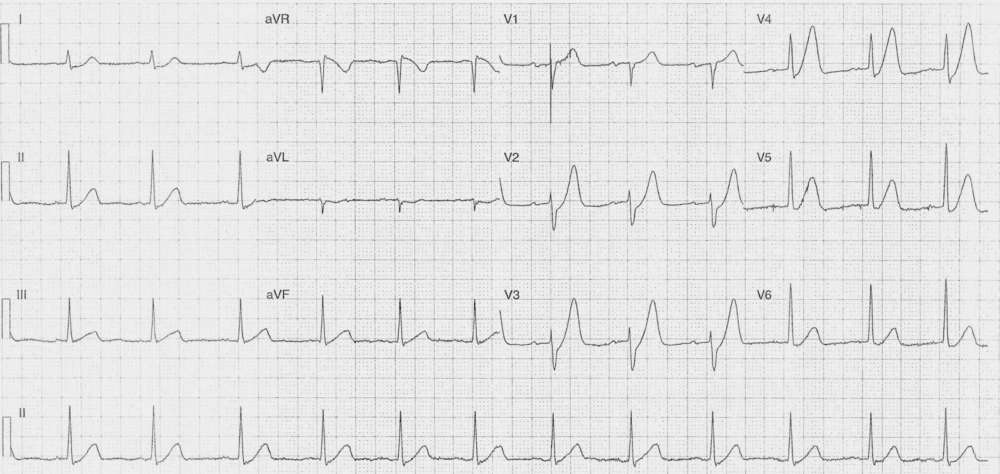 Read more about the article ECG Case 242