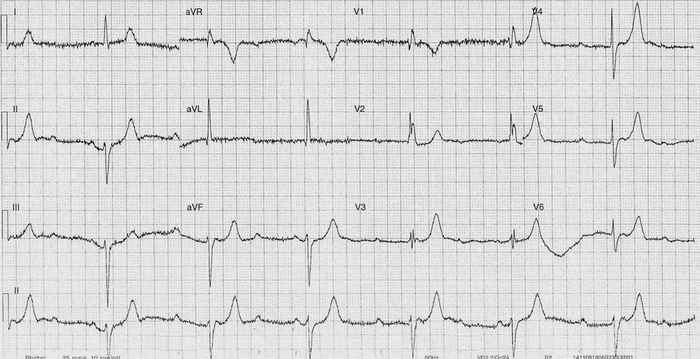 Read more about the article ECG Case 243