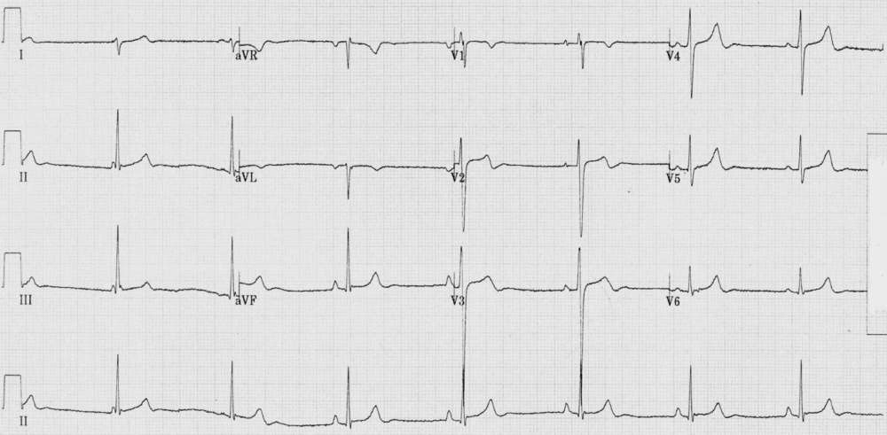 Read more about the article ECG Case 244