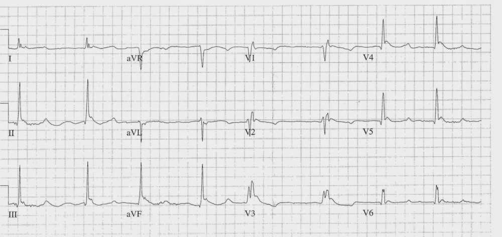 Slow Atrial Fibrillation with J-waves (Osborn waves)