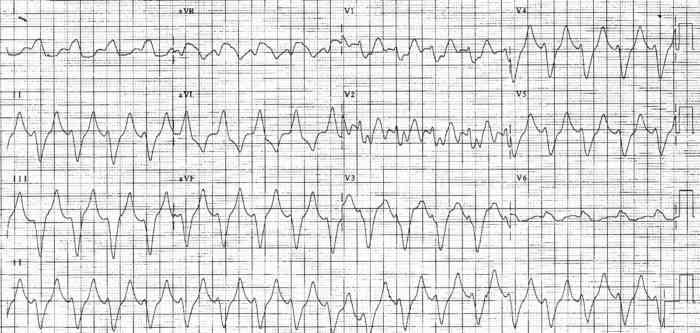 Read more about the article ECG Case 246