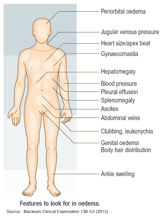 Features to look for in edema