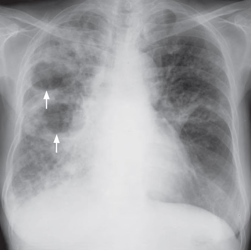 Frontal chest radiograph showing air-space opacification in the right lung with cavitating lesions (arrows) due to caseous necrosis in tuberculosis