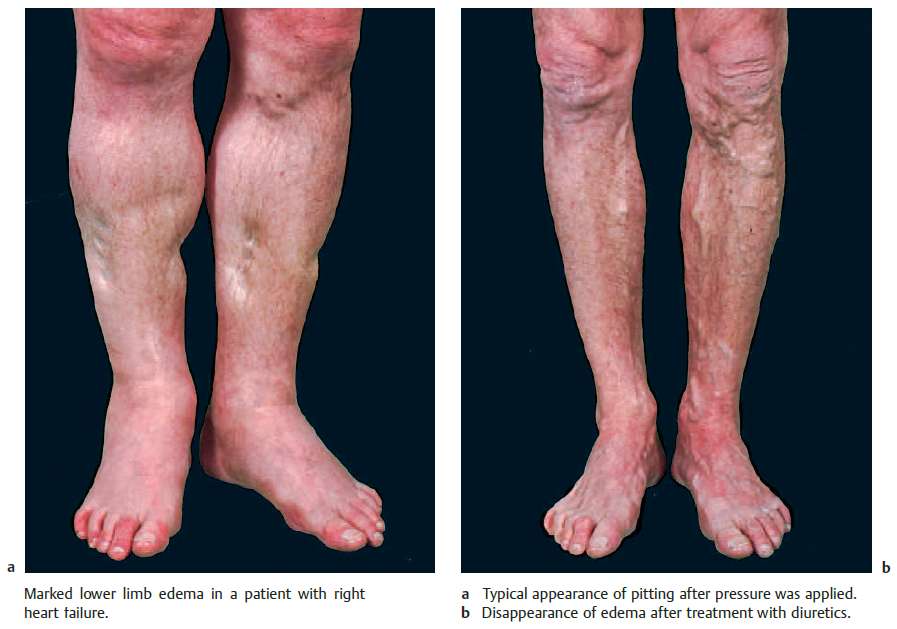 Marked lower limb (Extremity) edema in a patient with right heart failure