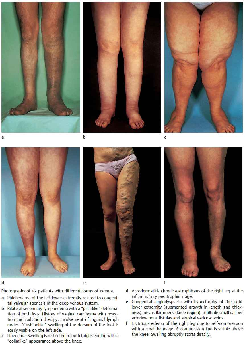 Photographs of six patients with different forms of edema (Phlebedema, Lymphedema, Lipedema, Acrodermatitis chronica atrophicans, Congeniral Angiodysplasia, Factitios Edema)