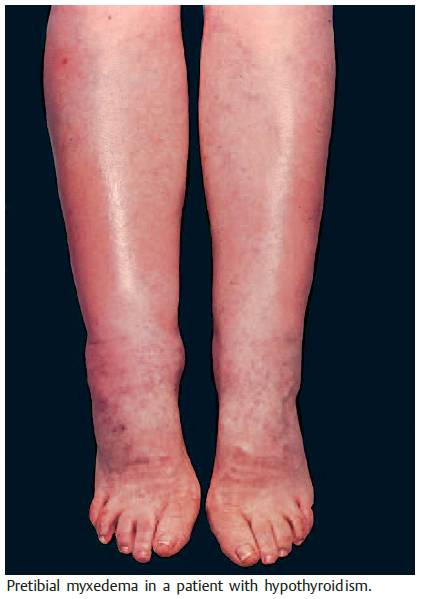 Pretibial myxedema in a patient with hypothyroidism