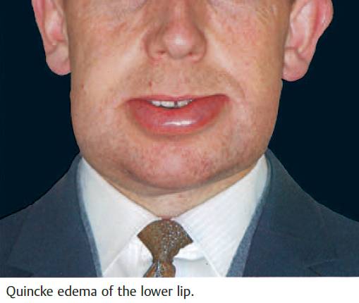 Quincke edema of the lower lip