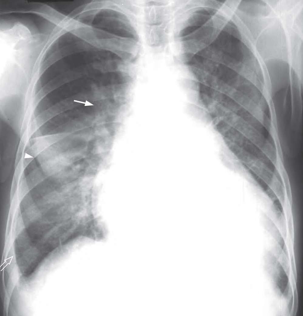 Congestive cardiac failure