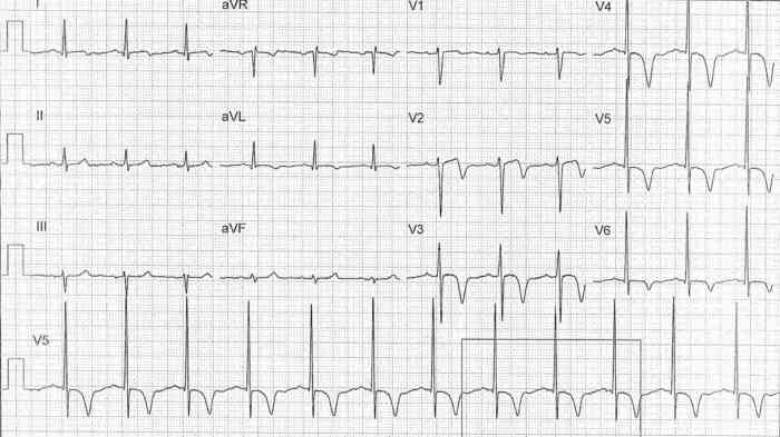 Read more about the article ECG Case 248