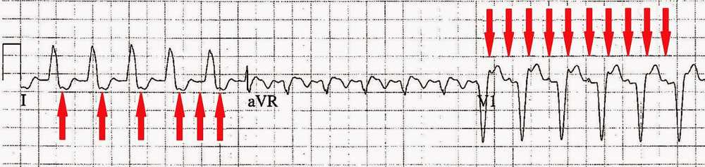 Atrial activity highlighted in leads I & V1