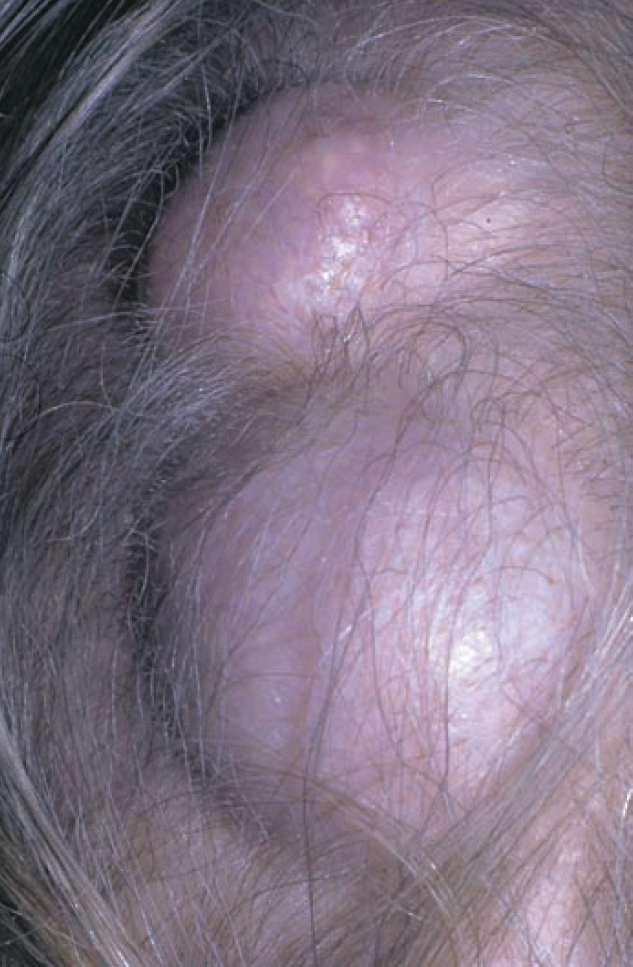 Read more about the article Lumps on the Scalp