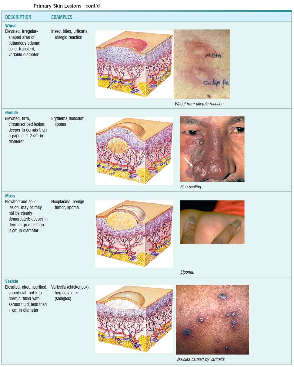 Primary Skin Lesions (Wheal, Nodule, Mass, Vesicle)