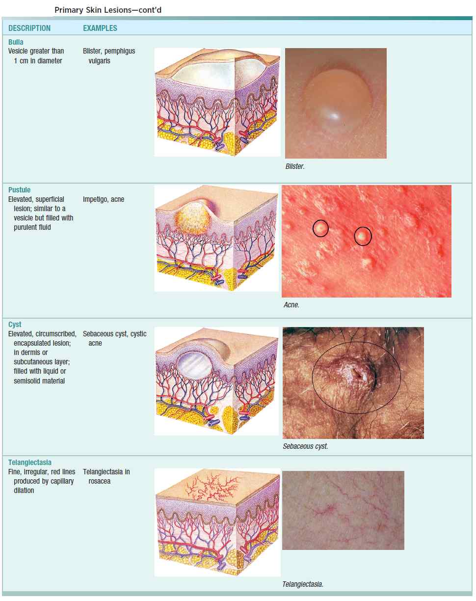 Primary Skin Lesions (Bulla, Pustule, Cyst, Teleangiectasia)