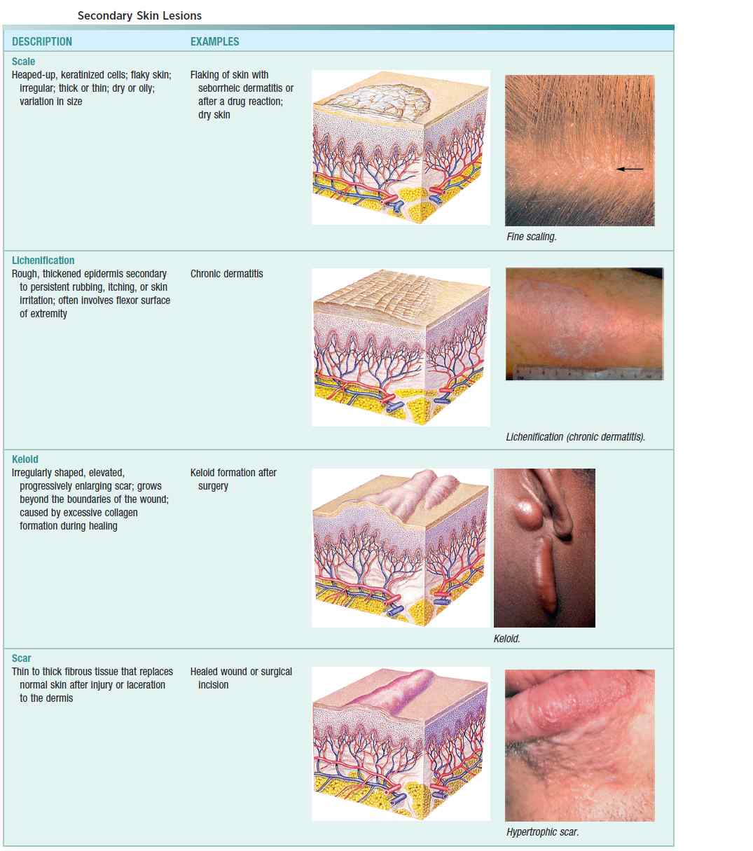 Secondary Skin Lesions (Scale, Lichineification, Keloid, Scar)