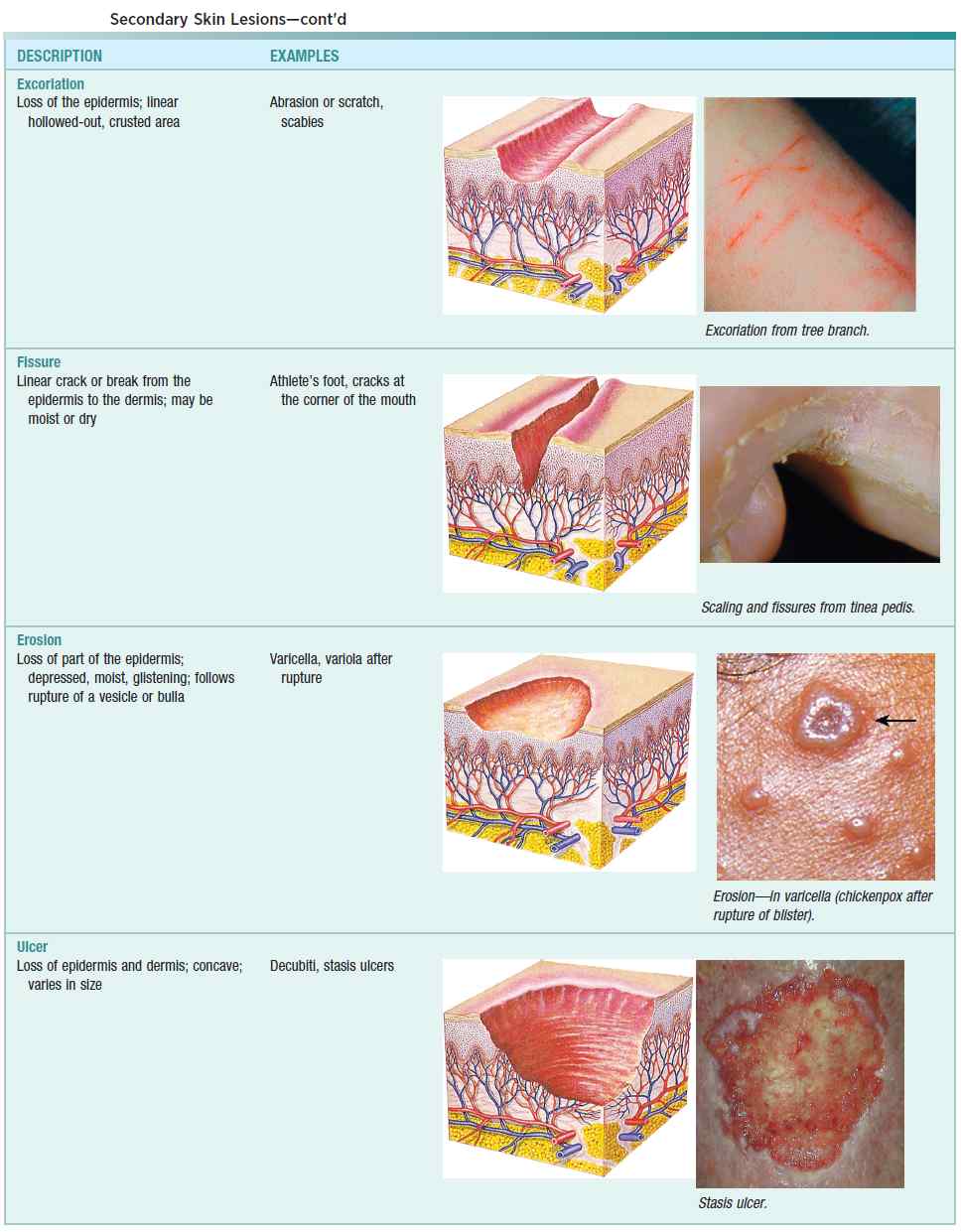 Secondary Skin Lesions (Excoriation, Fissure,Erosion, Ulcer)