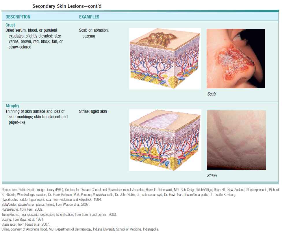 Secondary Skin Lesions (Crust, Atrophy)