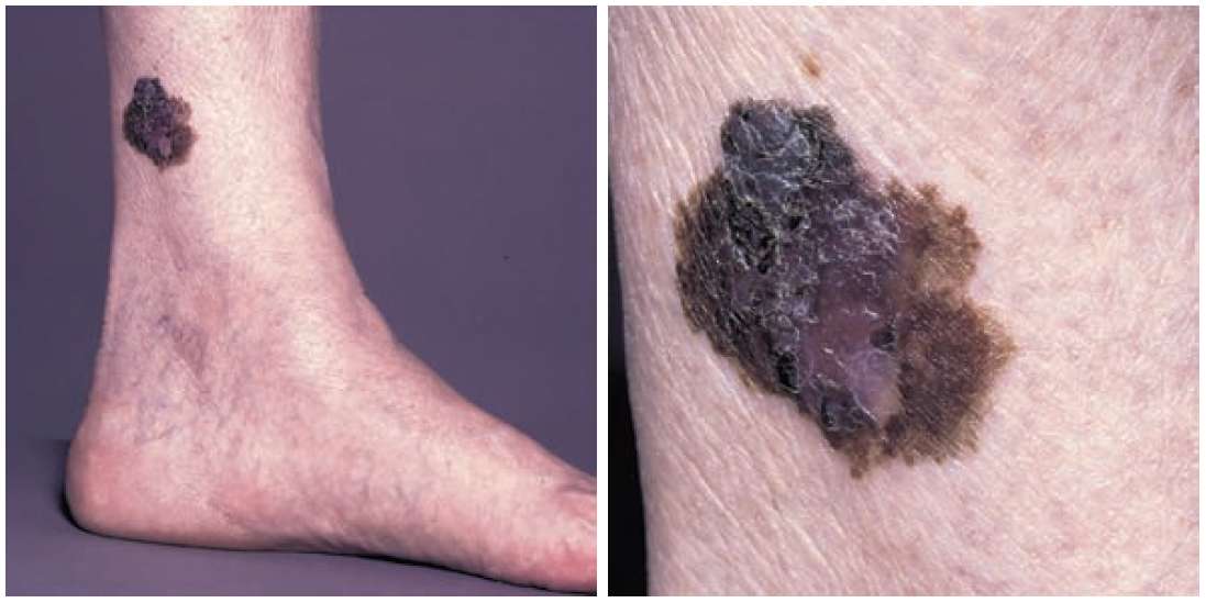 Read more about the article A Pigmented Skin Lesion that has Gotten Bigger