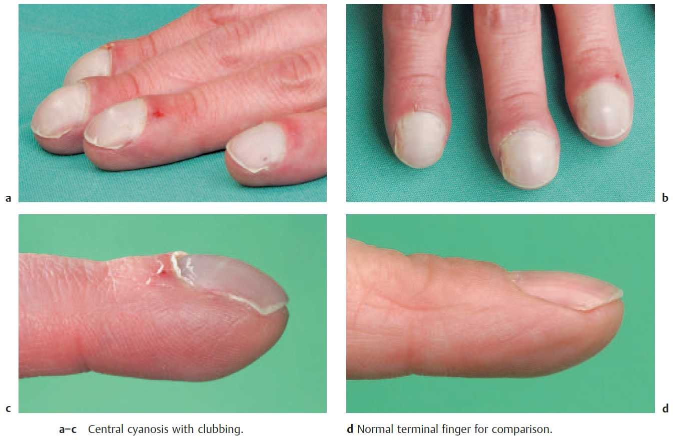 Central cyanosis with clubbing