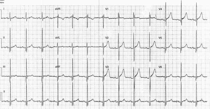 Read more about the article ECG Case 253