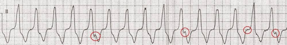 Rhythm strip - atrial activity circled