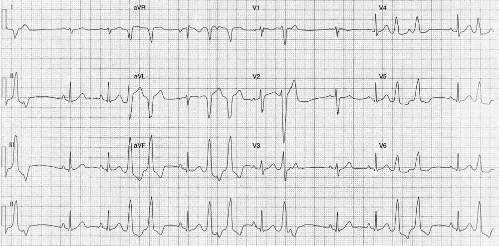 ECG Post vagal maneuver